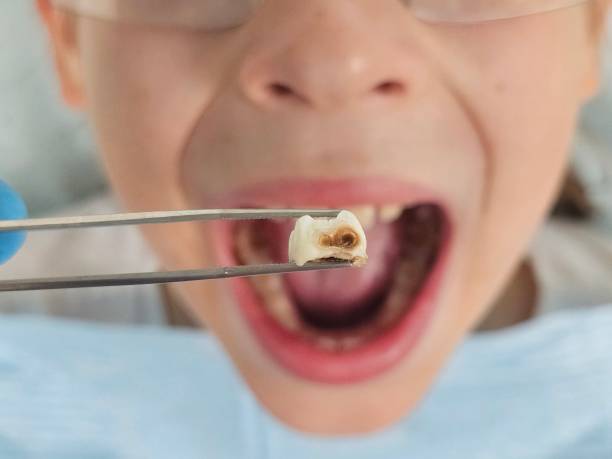 Best Emergency Root Canal Treatment in Streamwood, IL