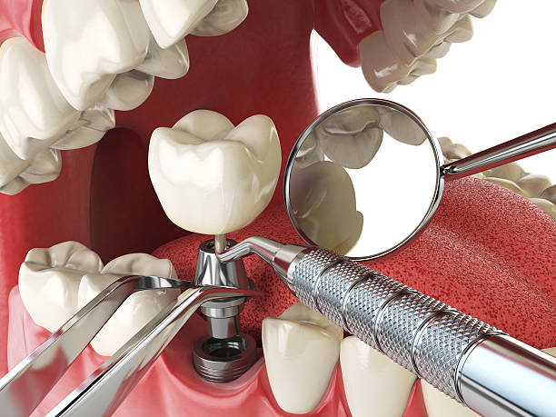 Best Broken or Cracked Tooth Emergency Dentist in Streamwood, IL